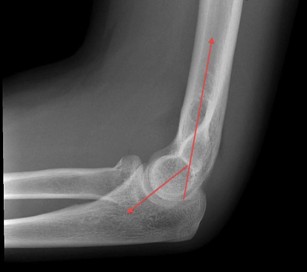 Elbow Trochela Anterior Angulation